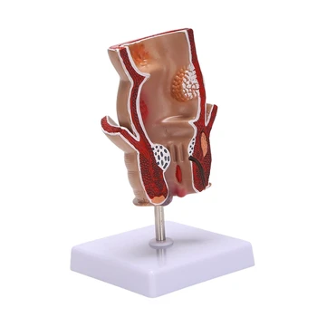 Анатомическая модель Модель геморроя прямой кишки человека Геморроидальный свищ Модель обучения патологии трещины